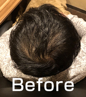 20代男性 発毛施術ビフォー