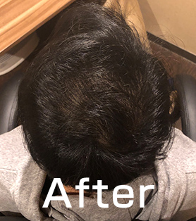 30代男性 発毛施術アフター