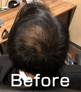 30代男性 発毛施術ビフォー