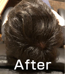 30代男性 発毛施術アフター