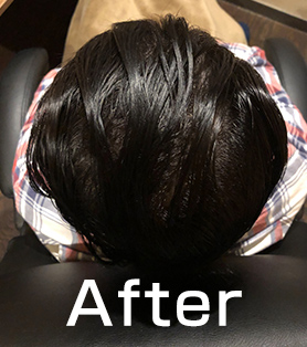 20代男性 発毛施術アフター