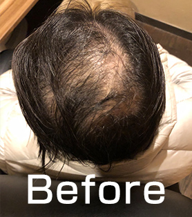 20代男性 発毛施術ビフォー